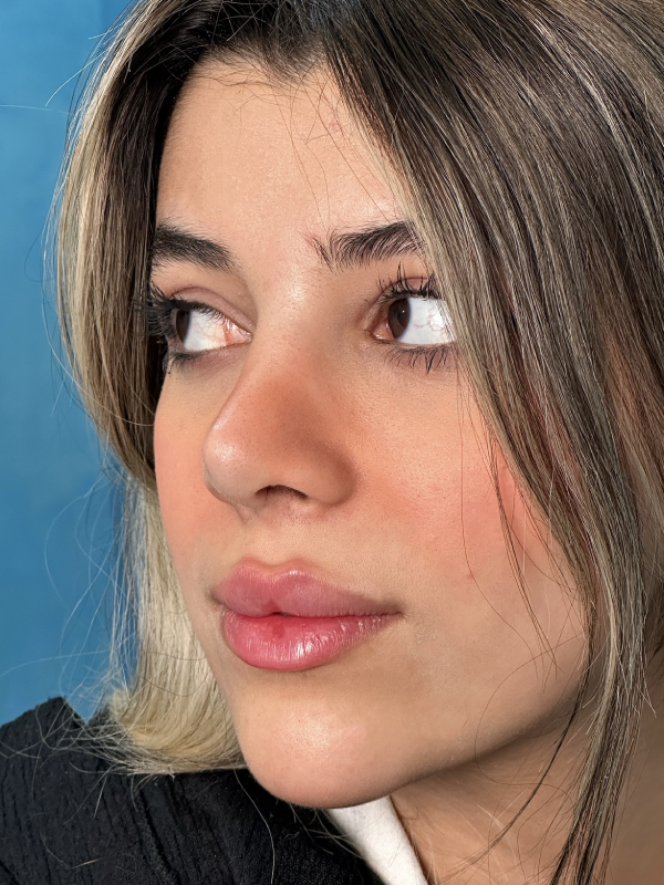تزریق فیلر چانه در اسلامشهر