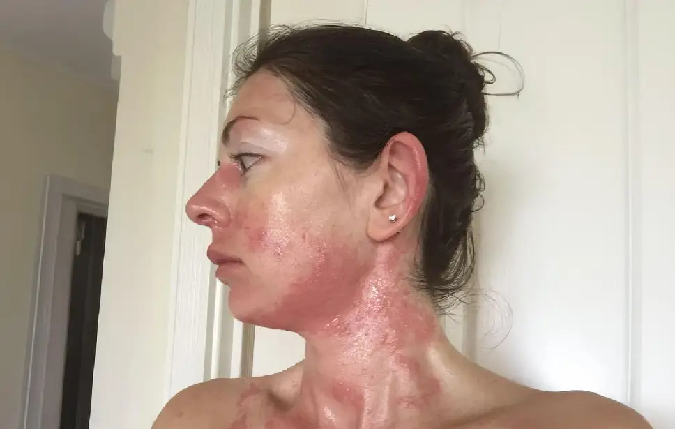 واکنش آلرژیک
