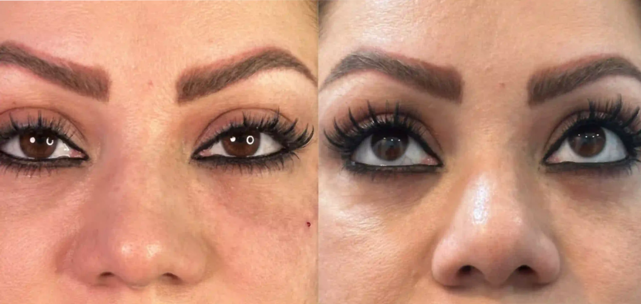 تزریق فیلر چشم اسلامشهر