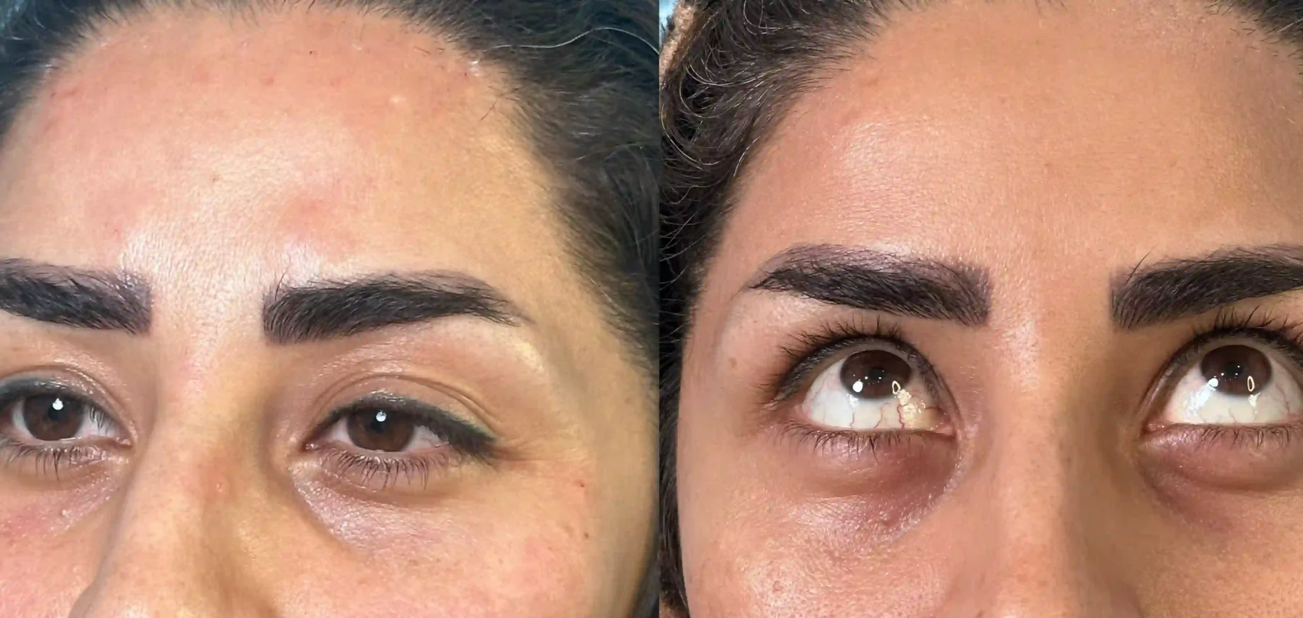 فیلر چشم اسلامشهر