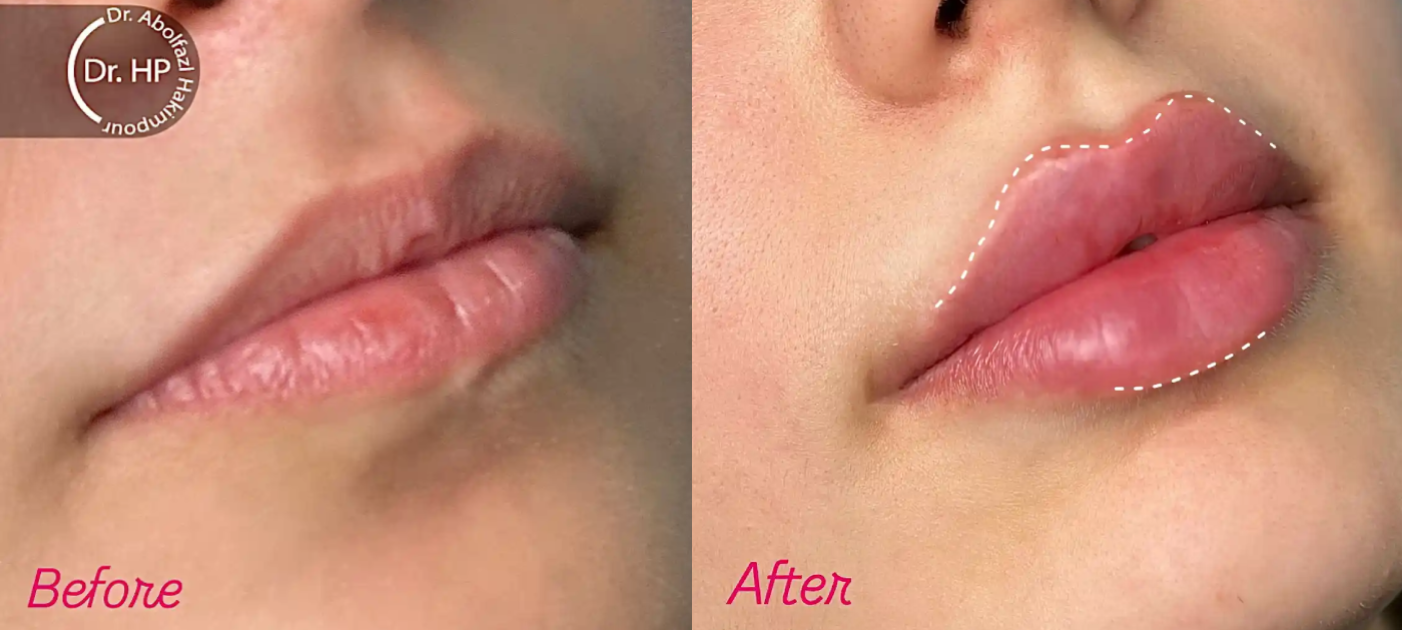 نمونهکار تزریق ژل لب در سعادت آباد