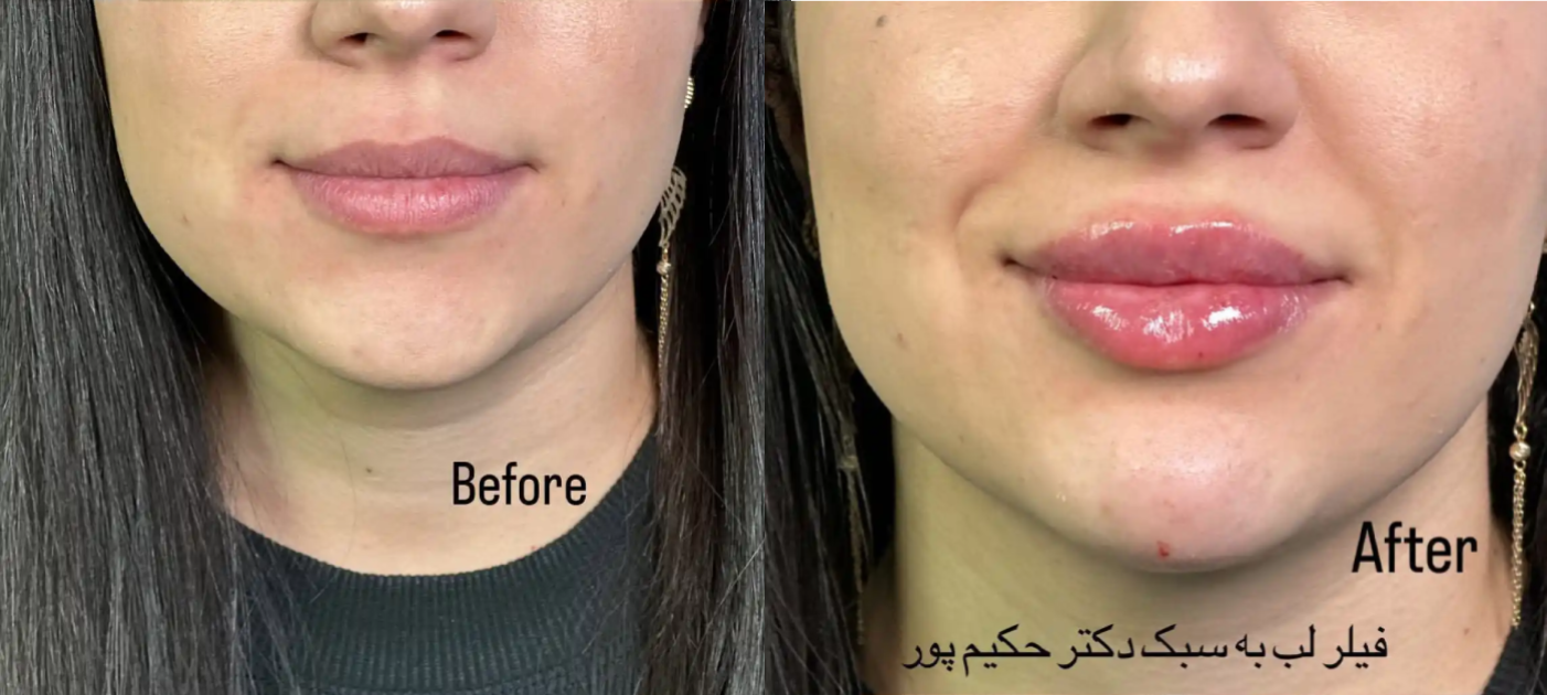 نمونهکار تزریق فیلر لب در سعادت آباد