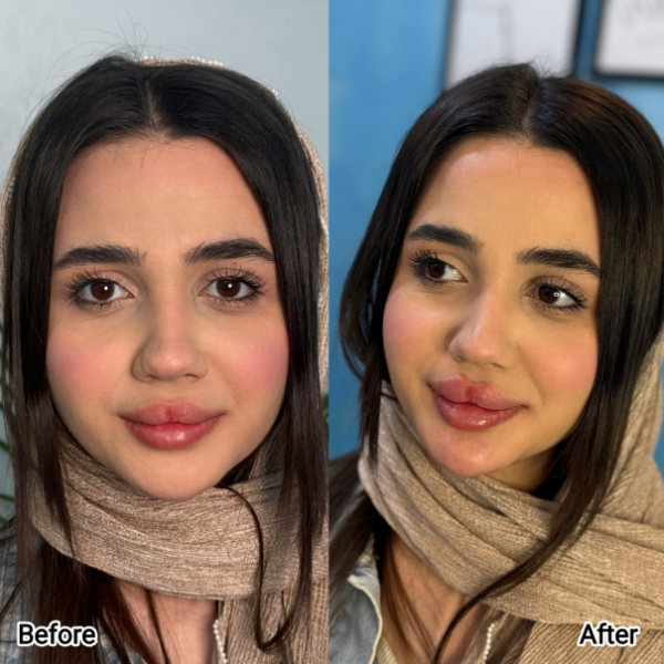 مقایسه قبل و بعد از فیلر صورت