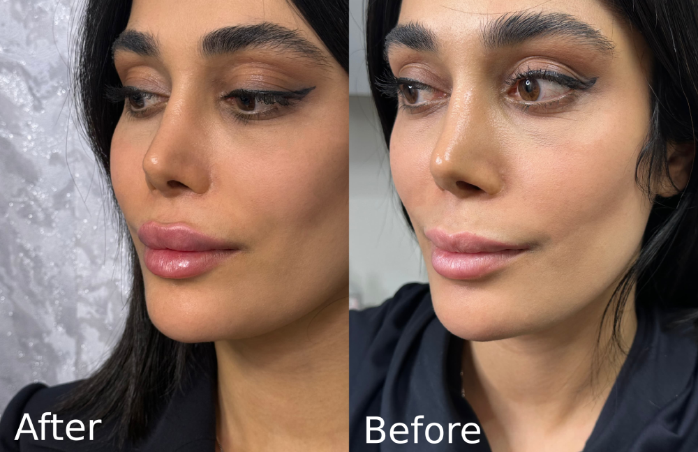تزریق فیلر گونه در سعادت آباد