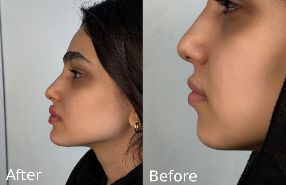 تزریق ژل گونه در سعادت آباد
