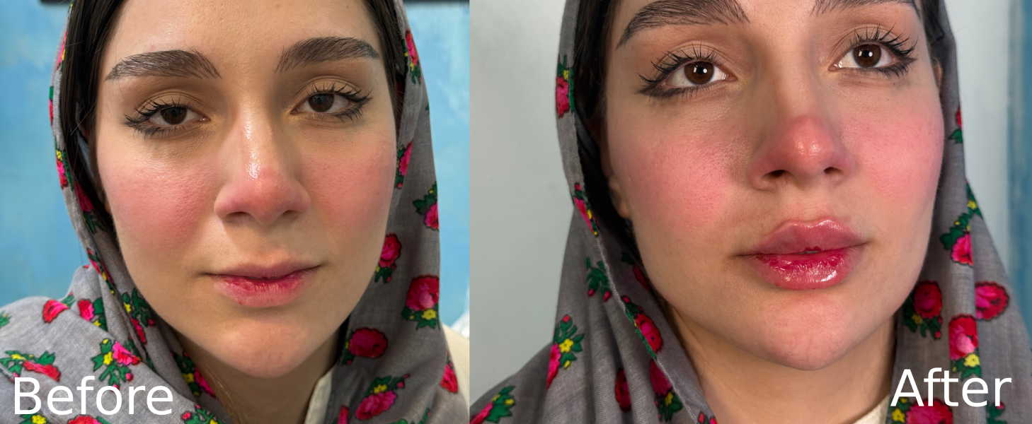 تزریق فیلر گونه در سعادت آباد