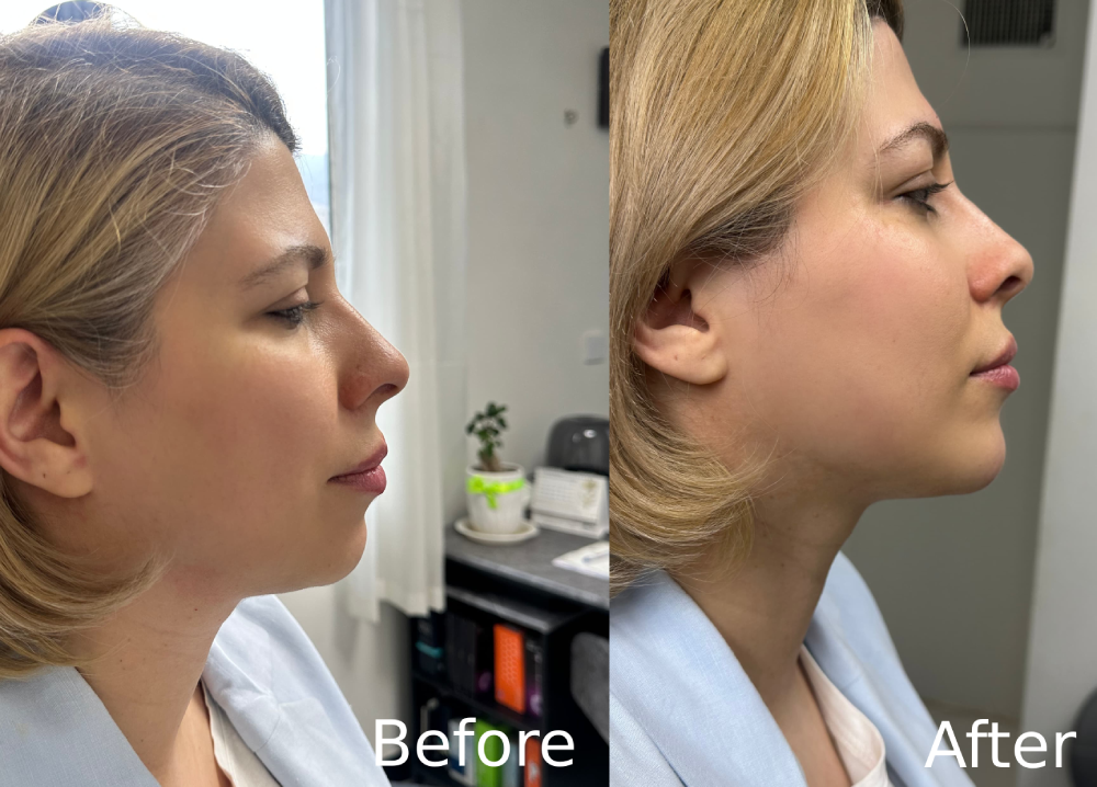 تزریق فیلر گونه در سعادت آباد
