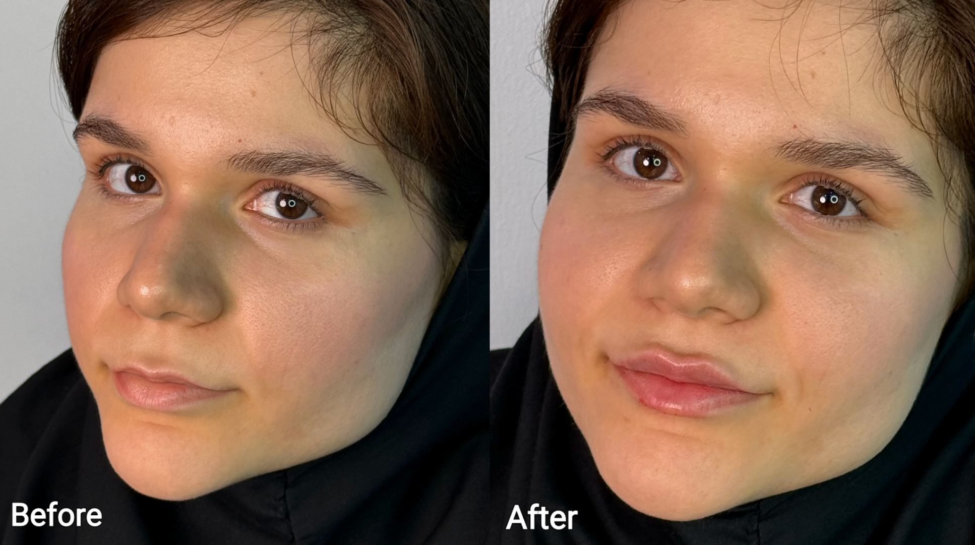 مقایسه فرم صورت قبل و بعد از تزریق