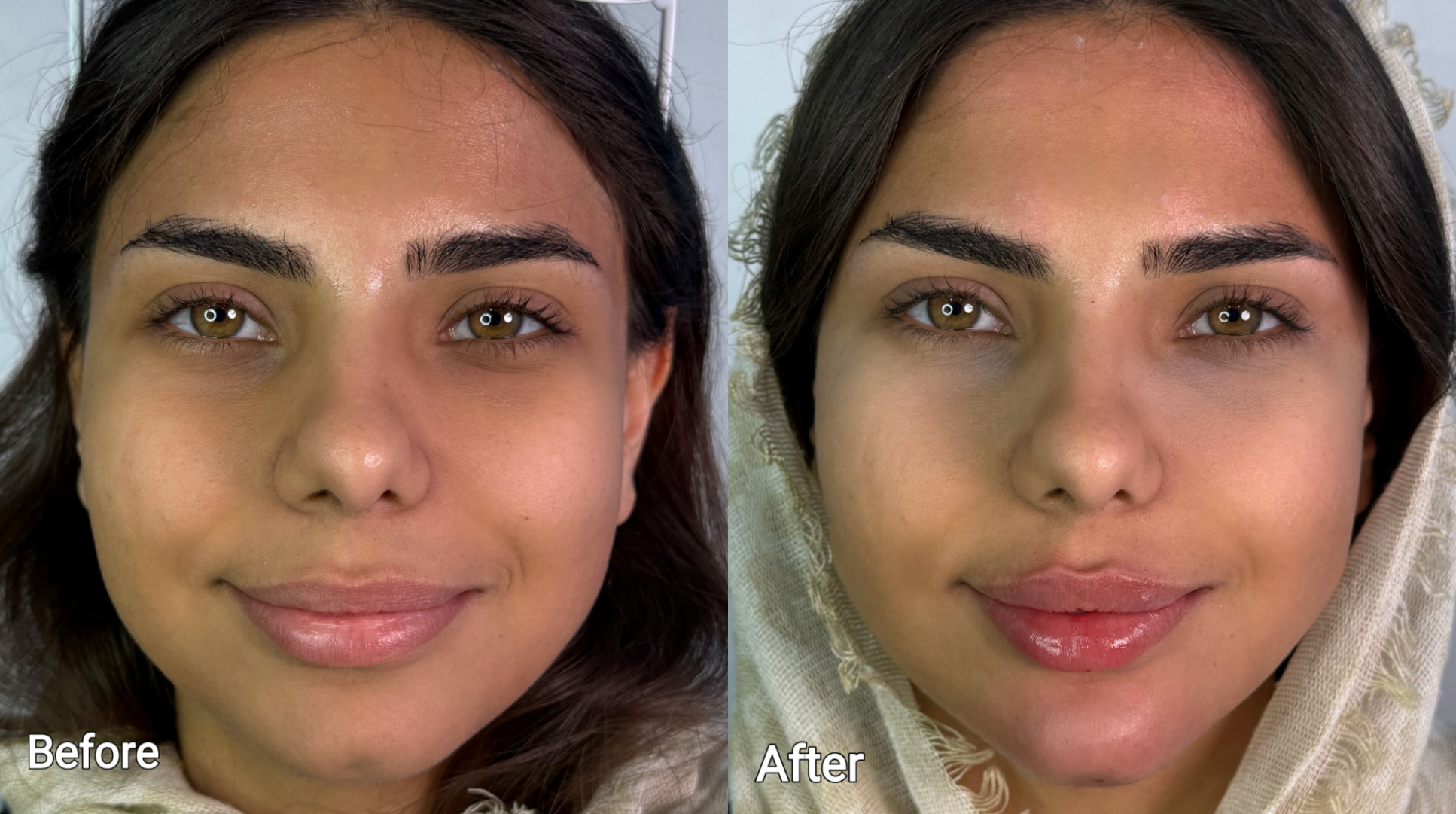 مقایسه فرم صورت قبل و بعد از تزریق زل