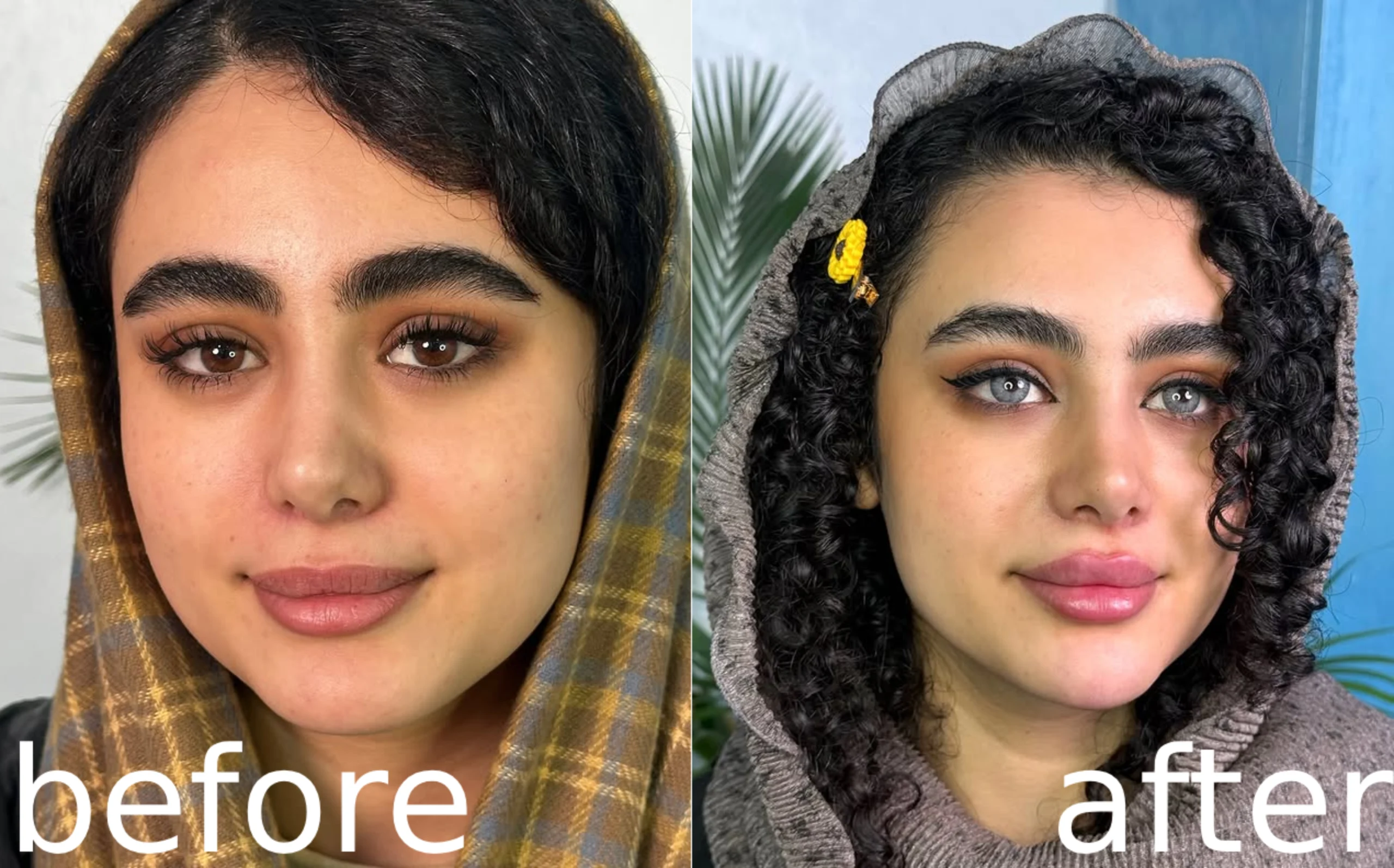 تغیرات زیباجو بعد از تزریق ژل